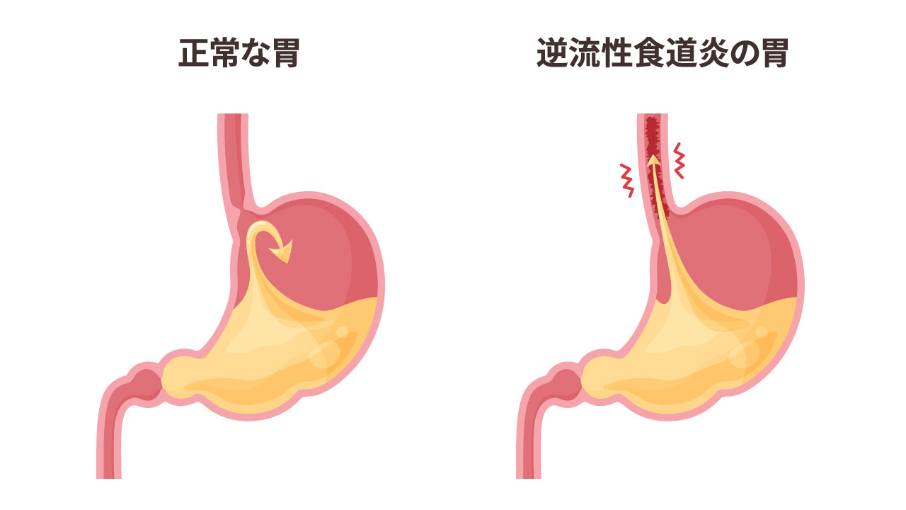 逆流性食道炎とは|逆流性食道炎4年、30代〜40代の筆者が逆流性食道炎を9割り完治させた、自己治療・付き合い方 