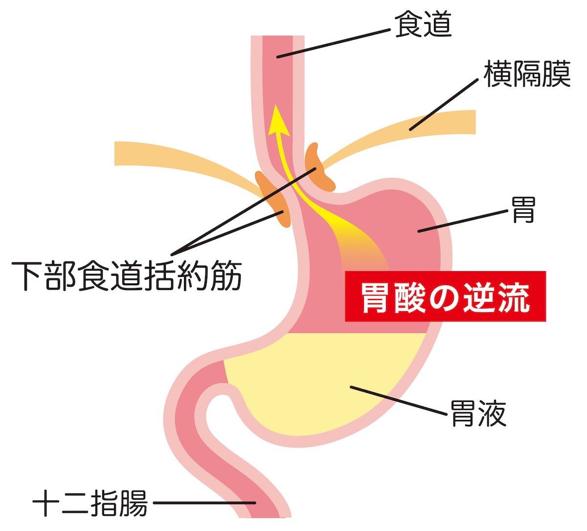 逆流性食道炎の原因は|逆流性食道炎4年、30代〜40代の筆者が逆流性食道炎を9割り完治させた、自己治療・付き合い方 