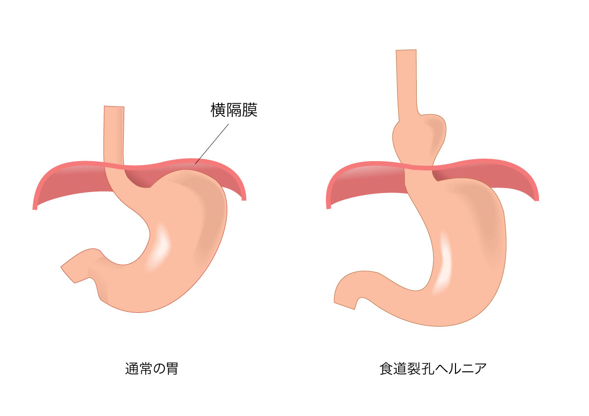 逆流性食道炎の原因は|逆流性食道炎4年、30代〜40代の筆者が逆流性食道炎を9割り完治させた、自己治療・付き合い方 