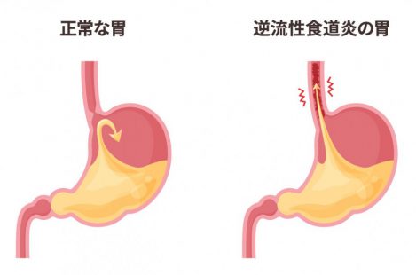 |逆流性食道炎4年、30代〜40代の筆者が逆流性食道炎を9割り完治させた、自己治療・付き合い方